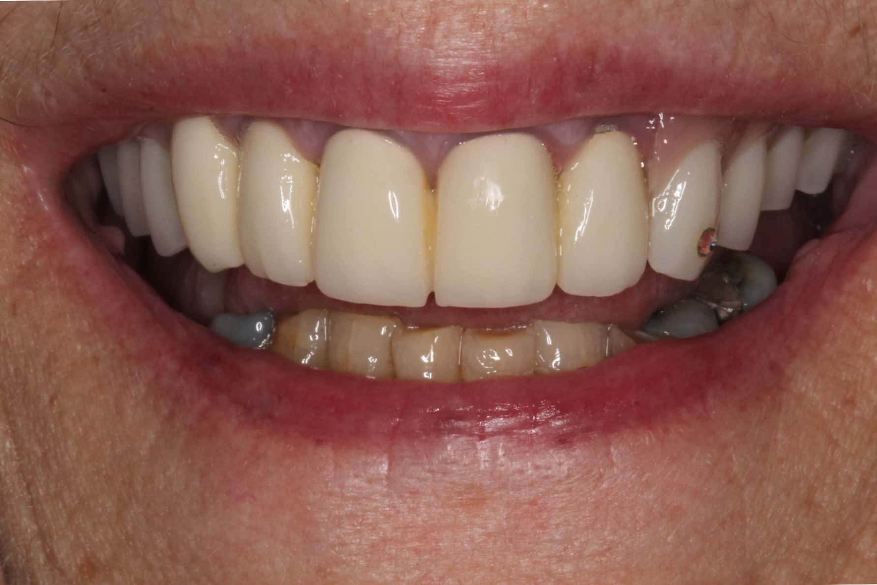 Illustrasjon av konusprotese og underliggende tenner.