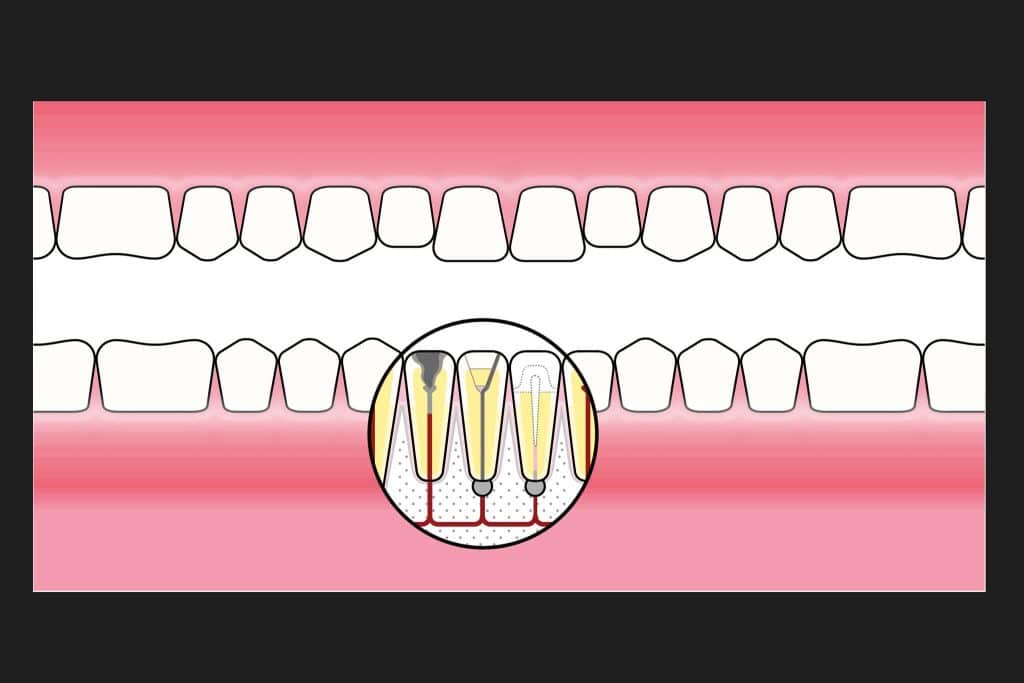 Ved Kolbotn Tannklinikk vises hvordan skadede rotfyllinger kan skape dårlig ånde – Kolbotn, Follo, Sofiemyr og Holmlia.