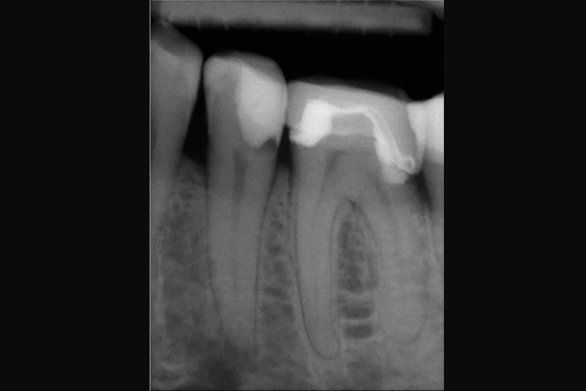 Før- og etterbilde: Hos Kolbotn Tannklinikk dokumenteres rotfylling med røntgen – tydelig resultat i Kolbotn, Follo, Vinterbro og Holmlia.