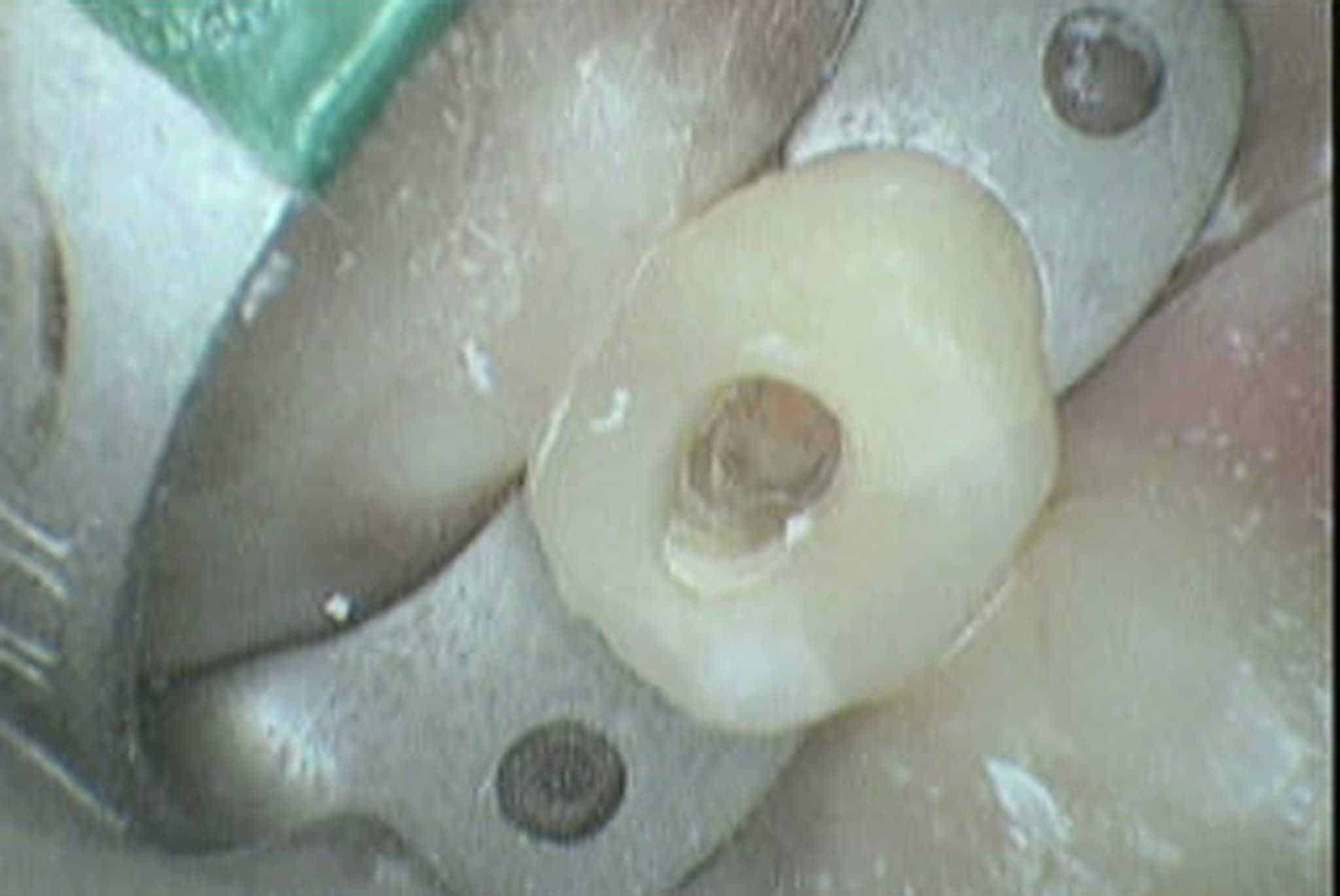 Før- og etterbilde: Hos Kolbotn Tannklinikk vises tann åpnet under rotfylling og ferdig fylt med tannfarget materiale – behandling i Kolbotn, Follo, Nordstrand og Myrvoll.