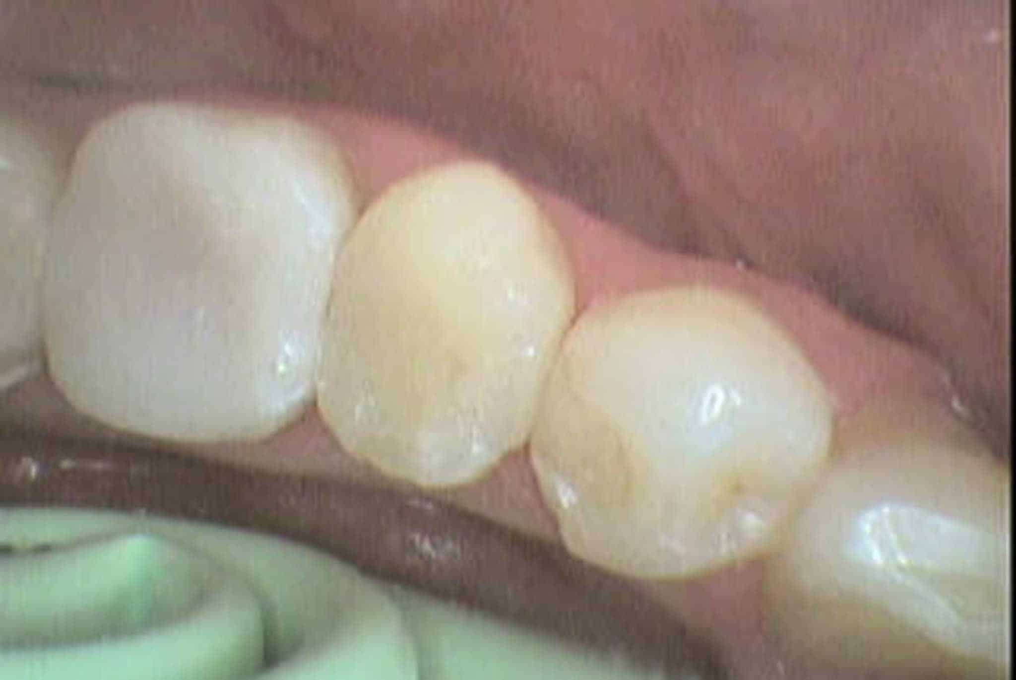 Før- og etterbilde: Hos Kolbotn Tannklinikk vises tann åpnet under rotfylling og ferdig fylt med tannfarget materiale – behandling i Kolbotn, Follo, Nordstrand og Myrvoll.