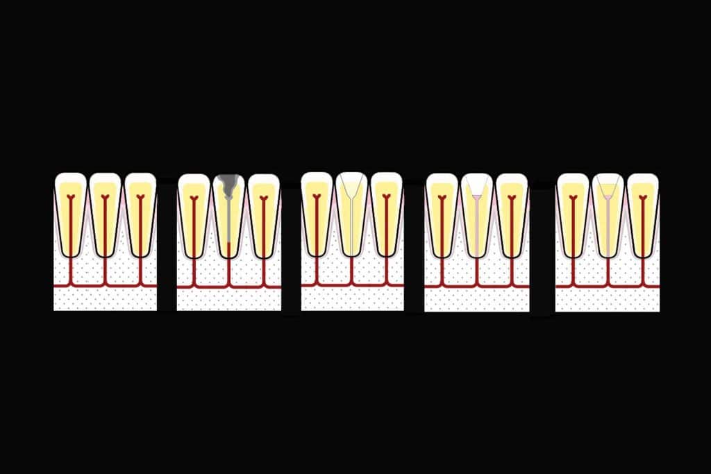 Ved Kolbotn Tannklinikk illustreres hvordan pulpitt behandles steg for steg med rotfylling – pasientinformasjon i Kolbotn, Oppegård og Nordstrand.