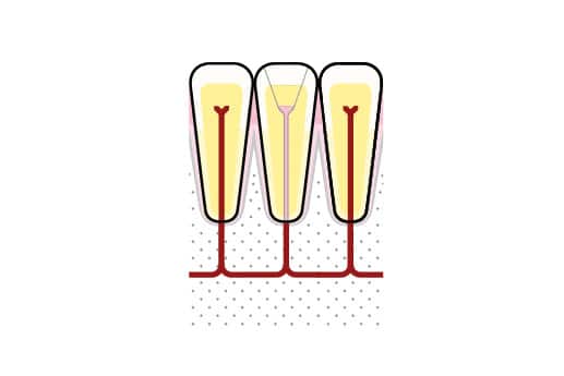 Før- og etterbilde: På Kolbotn Tannklinikk vises tann med apikal periodontitt før og etter rotfylling – trygg behandling i Kolbotn, Vinterbro og Nordstrand.
