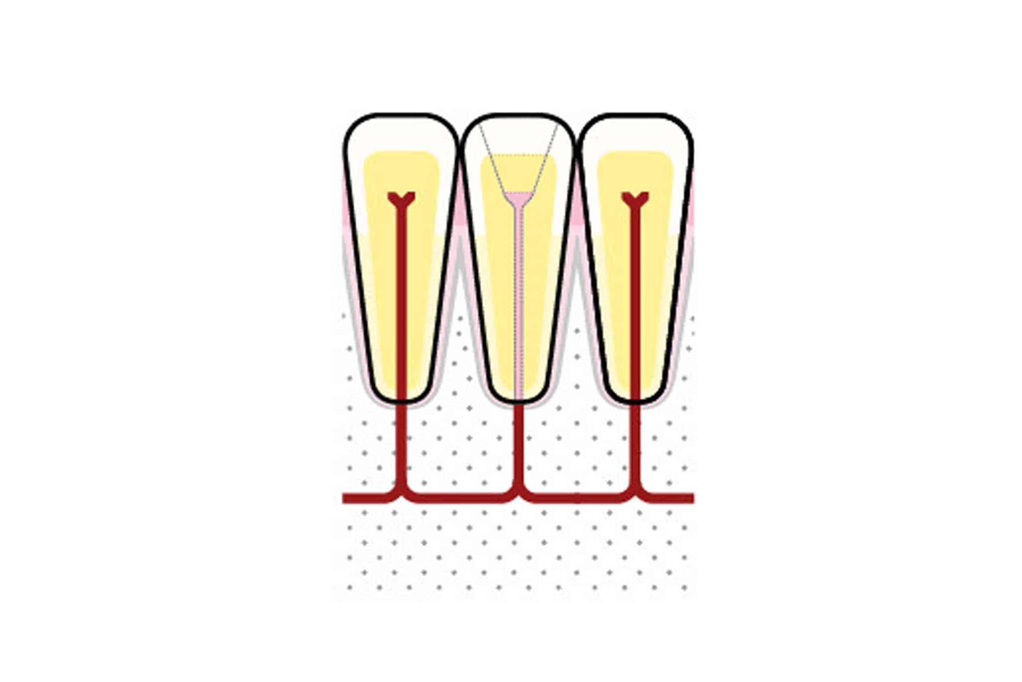 Før- og etterbilde: Ved Kolbotn Tannklinikk vises tann med nekrose før og etter rotfylling – behandling i Kolbotn, Vinterbro, Holmlia og Nordstrand.