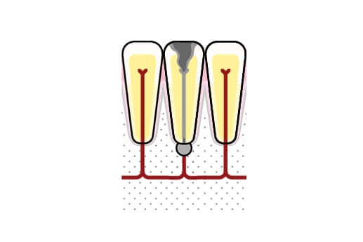 Hos Kolbotn Tannklinikk oppdager tannlegene apikal periodontitt med røntgen – tydelig infeksjon ved rotspissen behandlet i Kolbotn, Follo og Vinterbro.