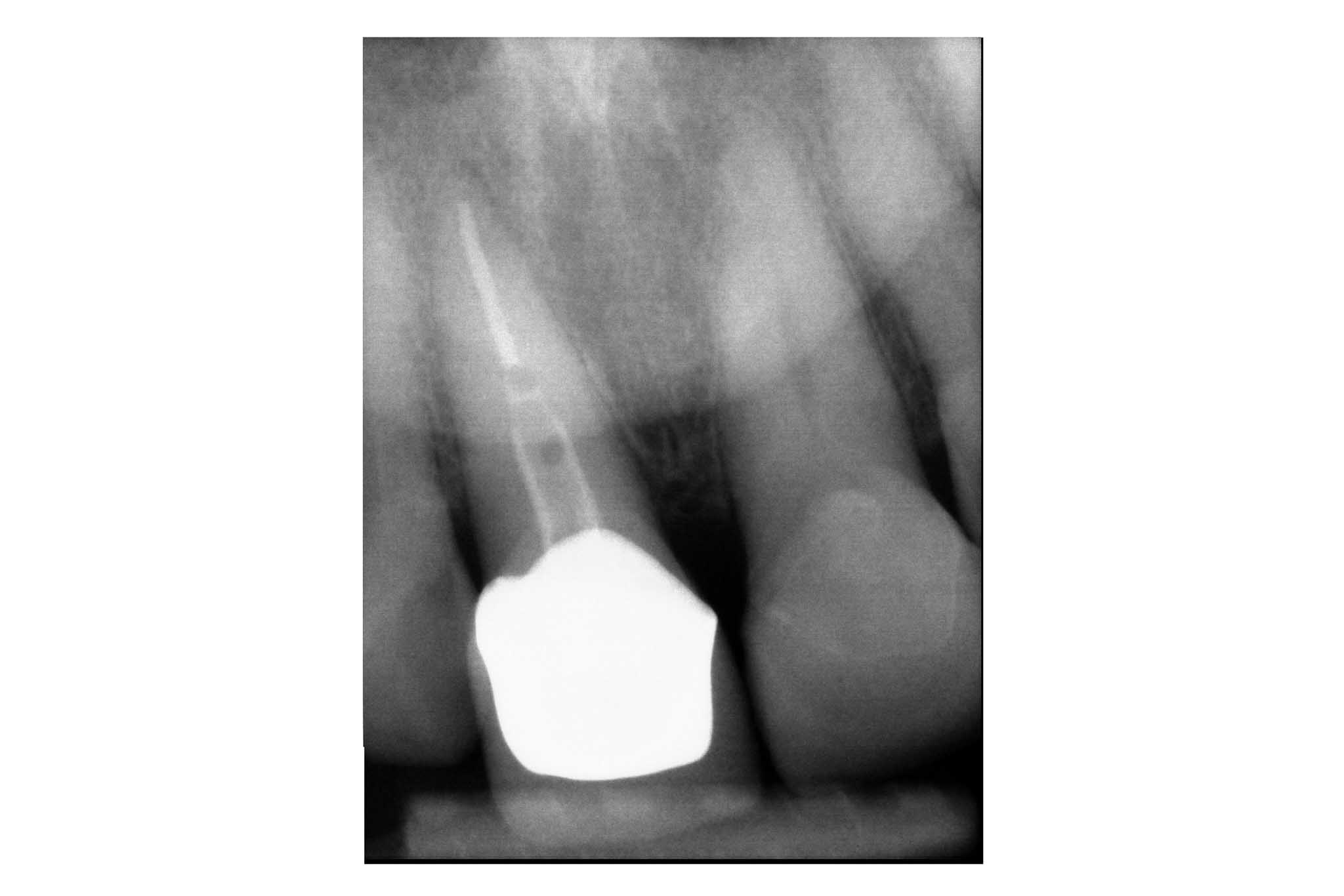 Før- og etterbilde: Hos Kolbotn Tannklinikk vises reinfeksjon etter rotfylling og behandlingsresultatet – tydelig forbedring i Kolbotn, Follo og Holmlia.