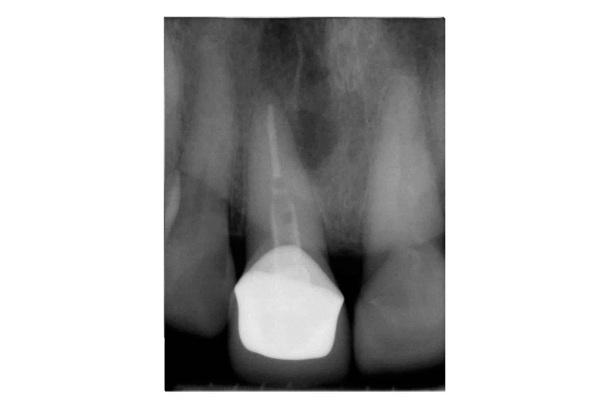 Før- og etterbilde: Hos Kolbotn Tannklinikk vises reinfeksjon etter rotfylling og behandlingsresultatet – tydelig forbedring i Kolbotn, Follo og Holmlia.