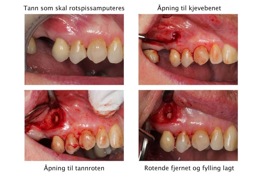 Galleri: På Kolbotn Tannklinikk vises prosessen fra frisk rotfylling, via infeksjon og rotspissamputasjon, til ferdig tilhelet område – pedagogisk bilde i Kolbotn, Myrvoll og Sofiemyr.