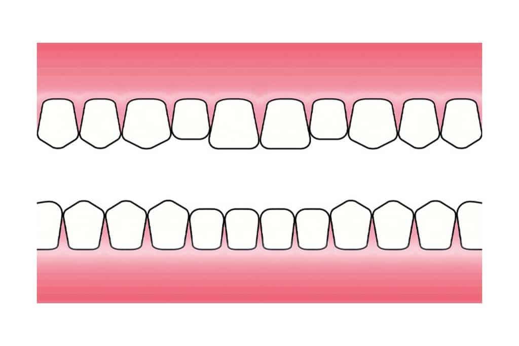 Før- og etterbilde: Hos Kolbotn Tannklinikk illustreres hvordan tanngnissing gir attrisjonsskader – informasjon til pasienter i Kolbotn, Follo og Oppegård.