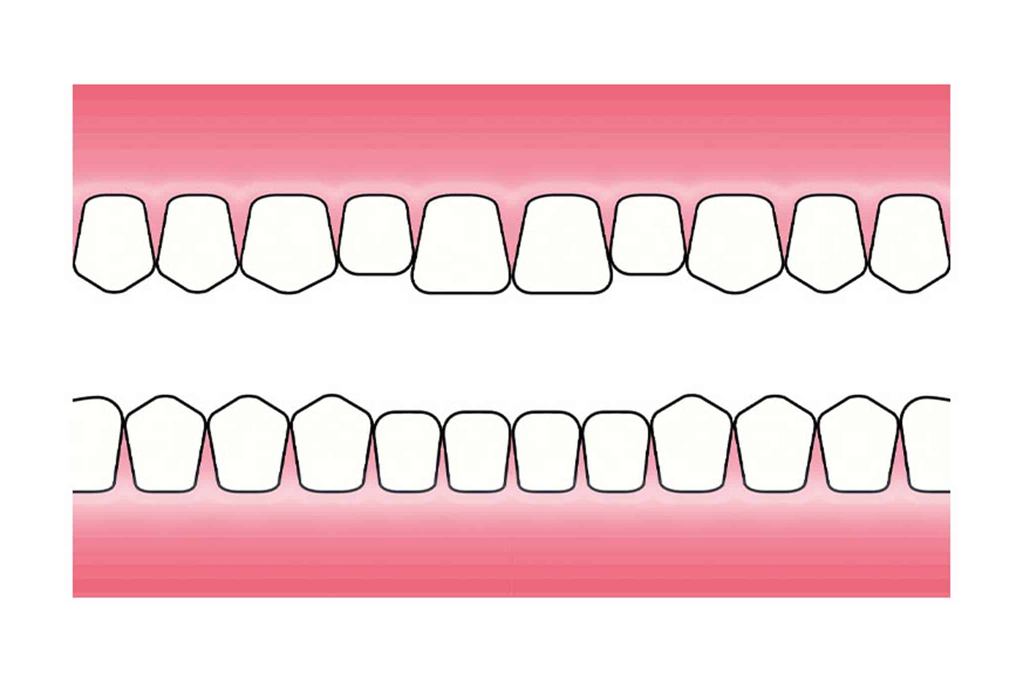 Før- og etterbilde: Hos Kolbotn Tannklinikk illustreres hvordan tanngnissing gir attrisjonsskader – informasjon til pasienter i Kolbotn, Follo og Oppegård.