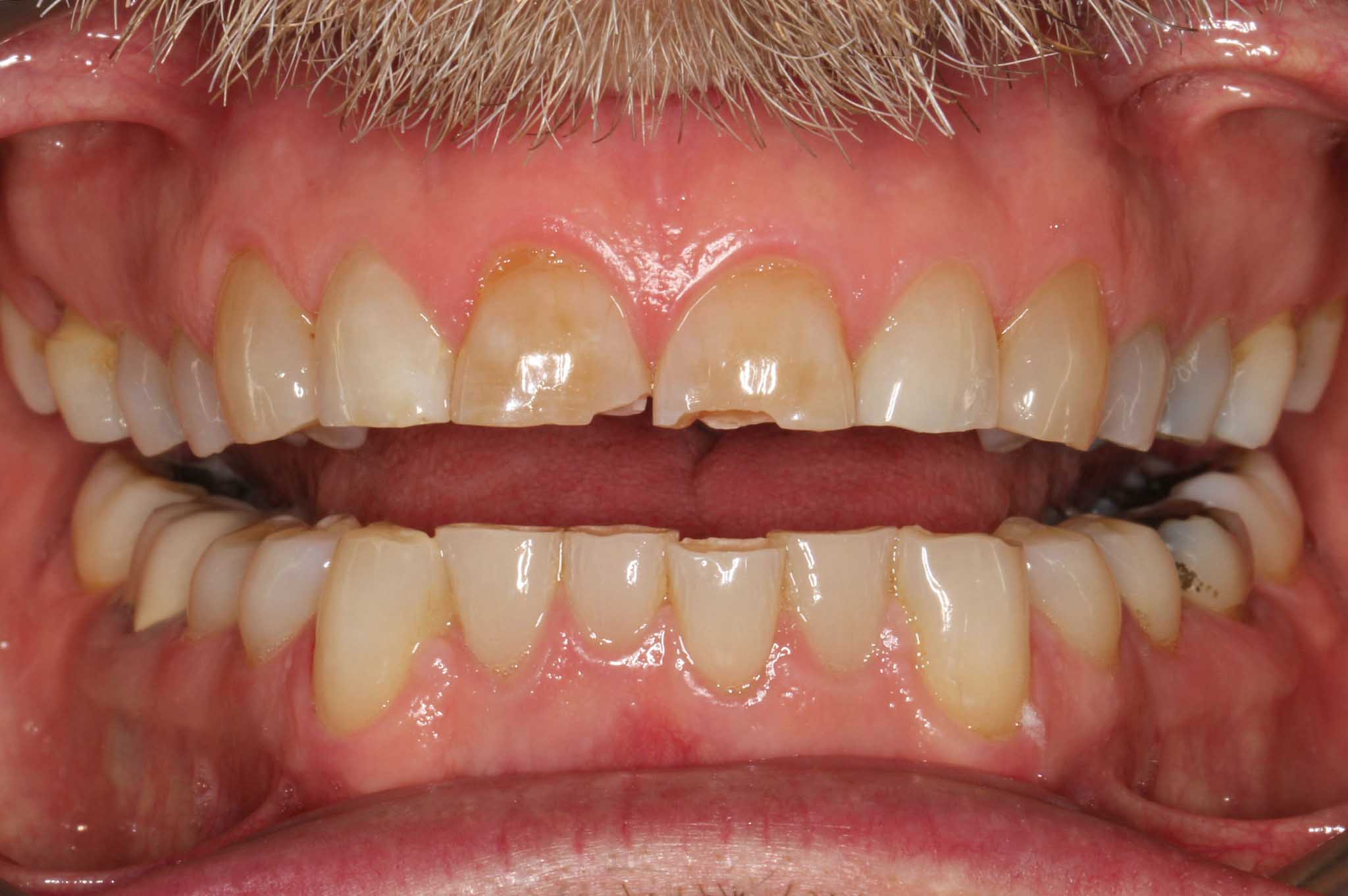 Hos Kolbotn Tannklinikk oppdages attrisjonsskader ved tanngnissing – diagnostikk i Kolbotn, Follo og Vinterbro.