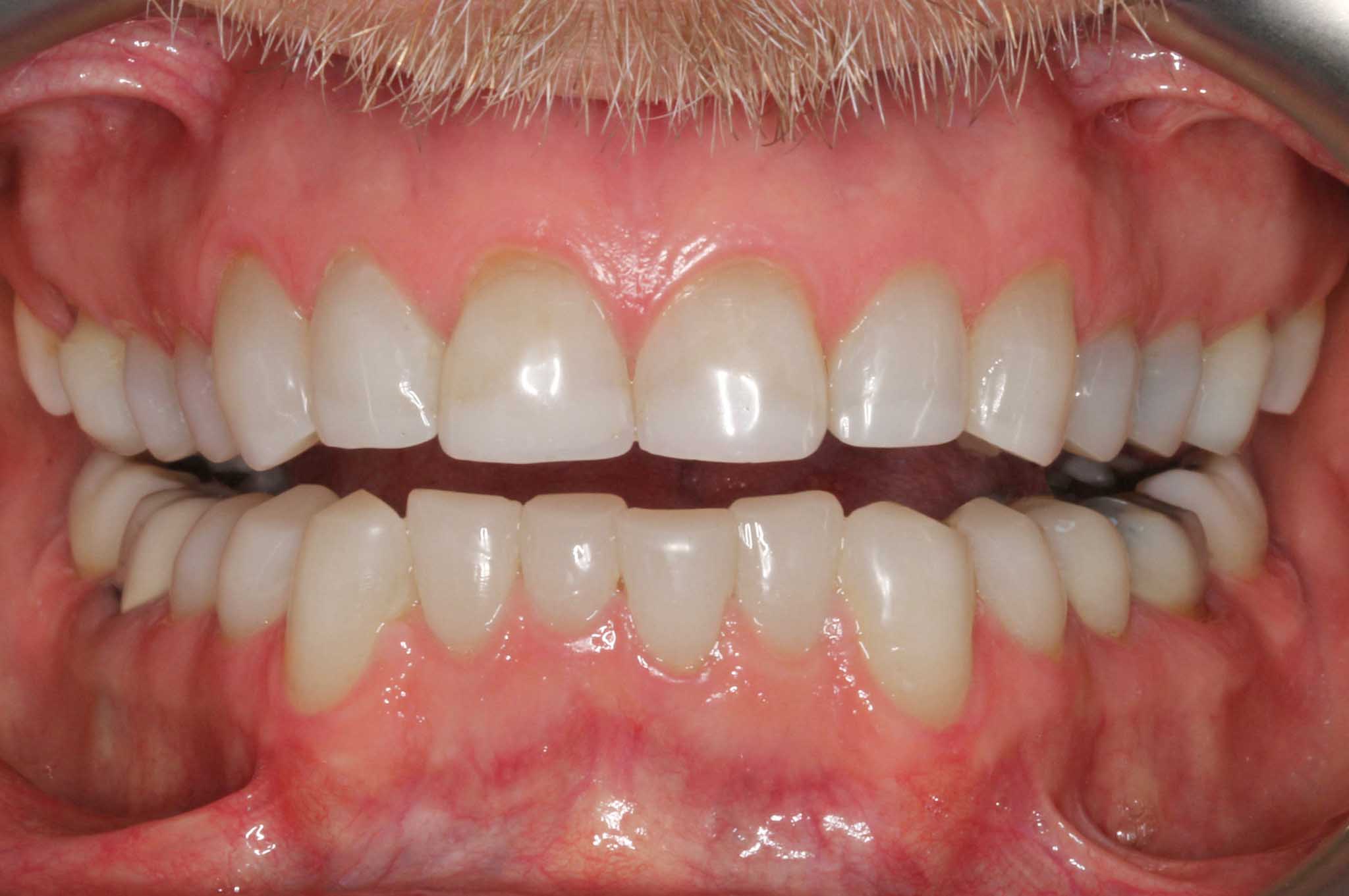 Før- og etterbilde: Hos Kolbotn Tannklinikk behandles tenner med attrisjonsskader fra tanngnissing og bygges opp med tannfarget fylling – trygg behandling i Kolbotn, Follo, Oppegård og Myrvoll.