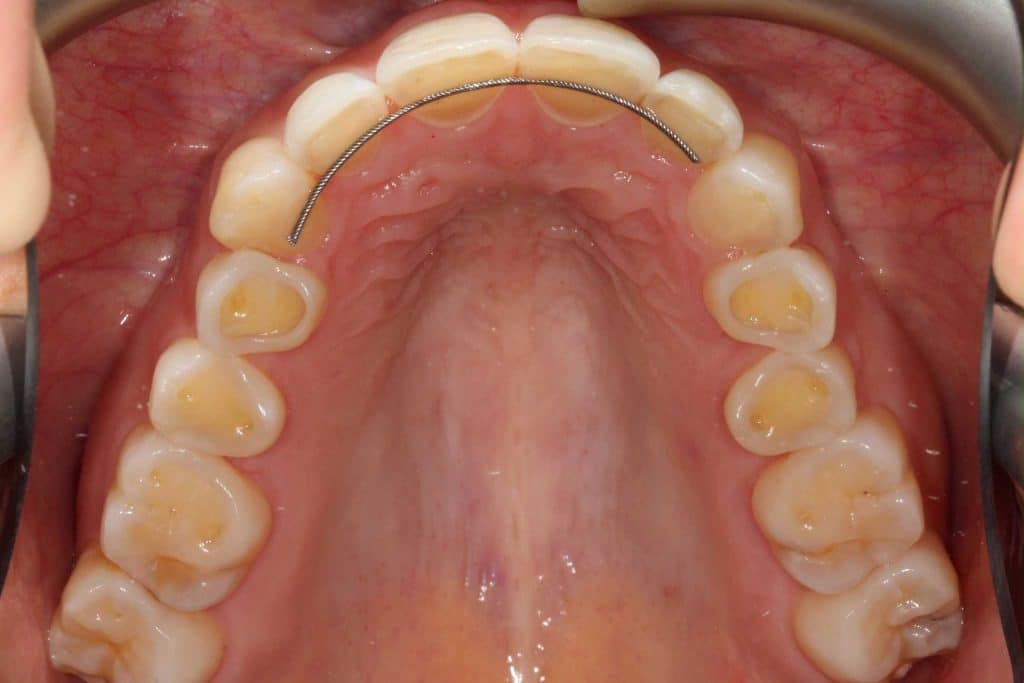 Ved Kolbotn Tannklinikk diagnostiseres erosjonsskader forårsaket av syrepåvirkning – behandling i Kolbotn, Follo og Nordstrand.