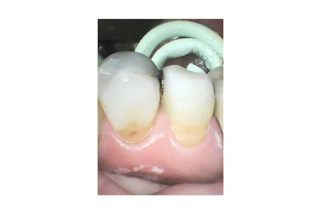 Før- og etterbilde: Ved Kolbotn Tannklinikk bygges pusseskader opp igjen med tannfarget fylling – behandling i Kolbotn, Follo, Sofiemyr og Myrvoll.