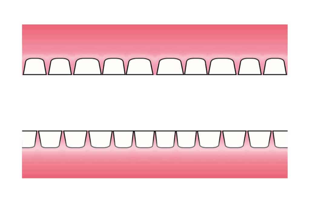 Før- og etterbilde: Hos Kolbotn Tannklinikk illustreres hvordan tanngnissing gir attrisjonsskader – informasjon til pasienter i Kolbotn, Follo og Oppegård.