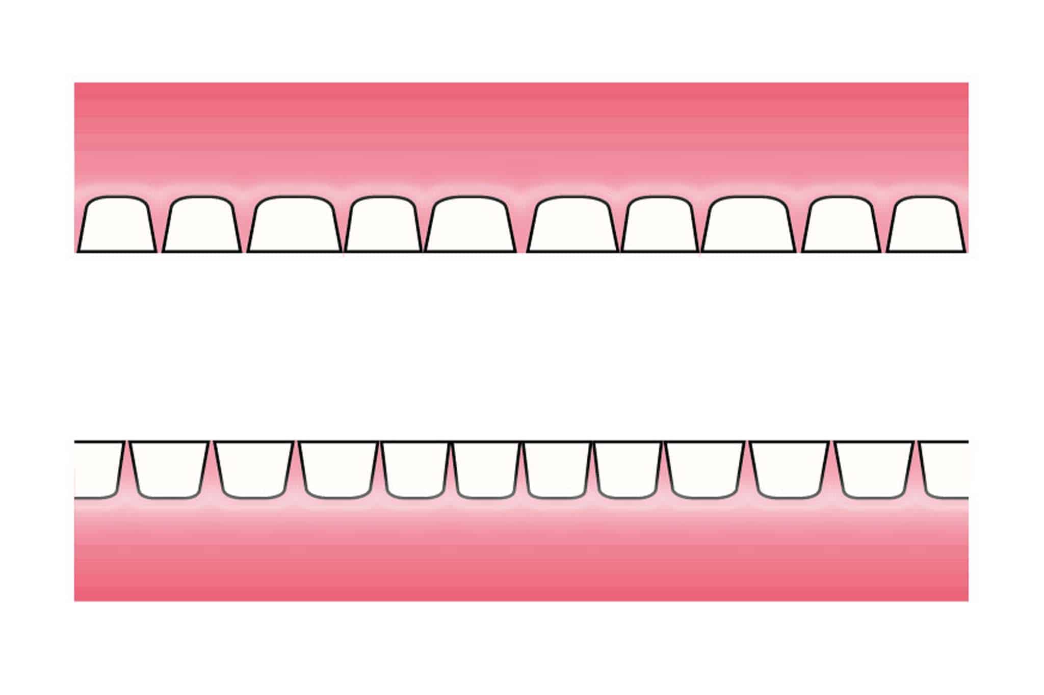 Før- og etterbilde: Hos Kolbotn Tannklinikk illustreres hvordan tanngnissing gir attrisjonsskader – informasjon til pasienter i Kolbotn, Follo og Oppegård.