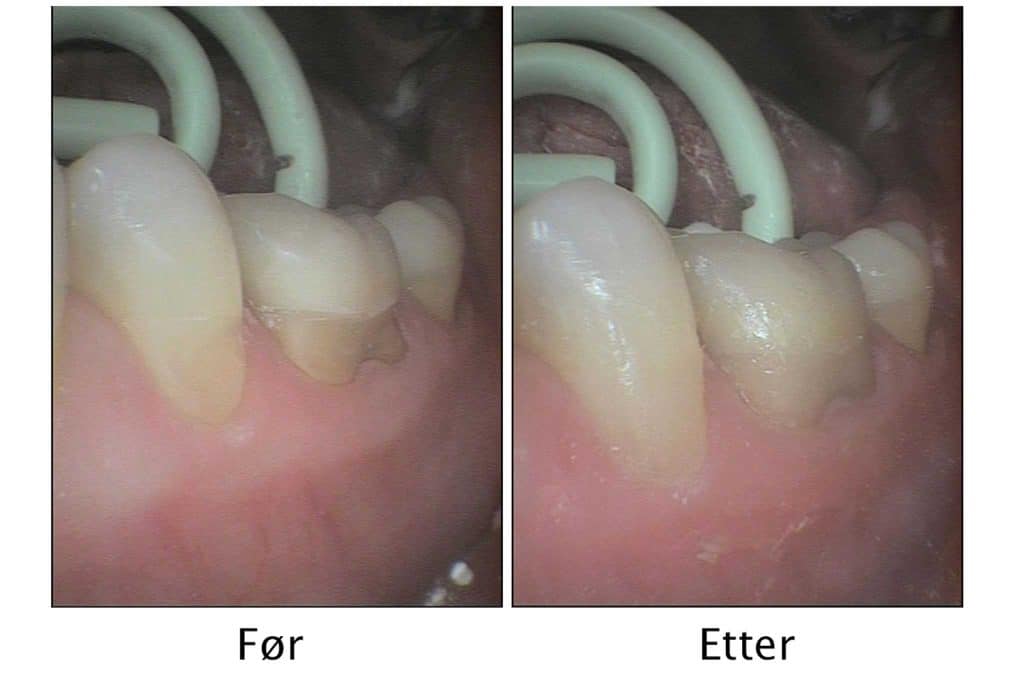 Galleri: På Kolbotn Tannklinikk behandles pusseskader med tannfarget fylling – behandling i Kolbotn, Vinterbro og Holmlia.