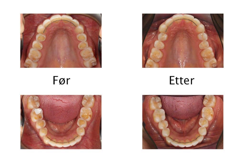 Galleri: Ved Kolbotn Tannklinikk repareres syreskader med fyllingsmateriale – behandling i Kolbotn, Myrvoll og Nordstrand.
