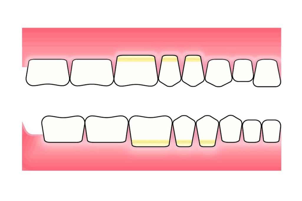 Hos Kolbotn Tannklinikk vises abfraksjonsskader som kileformede defekter ved tannhalsen – informasjon til pasienter i Kolbotn, Vinterbro og Greverud.