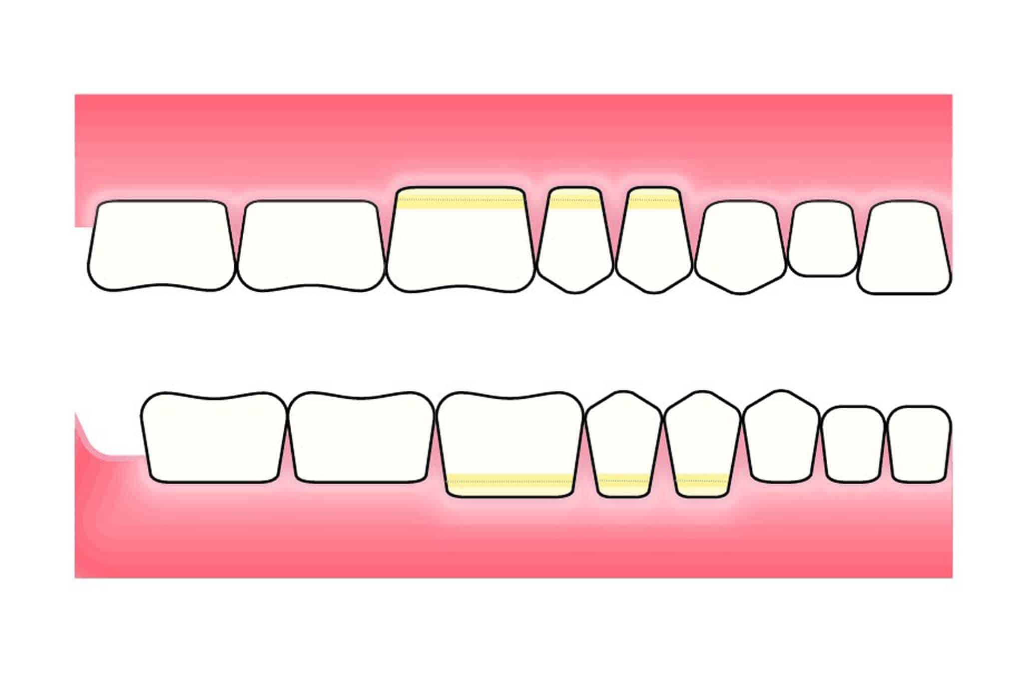 Hos Kolbotn Tannklinikk vises abfraksjonsskader som kileformede defekter ved tannhalsen – informasjon til pasienter i Kolbotn, Vinterbro og Greverud.