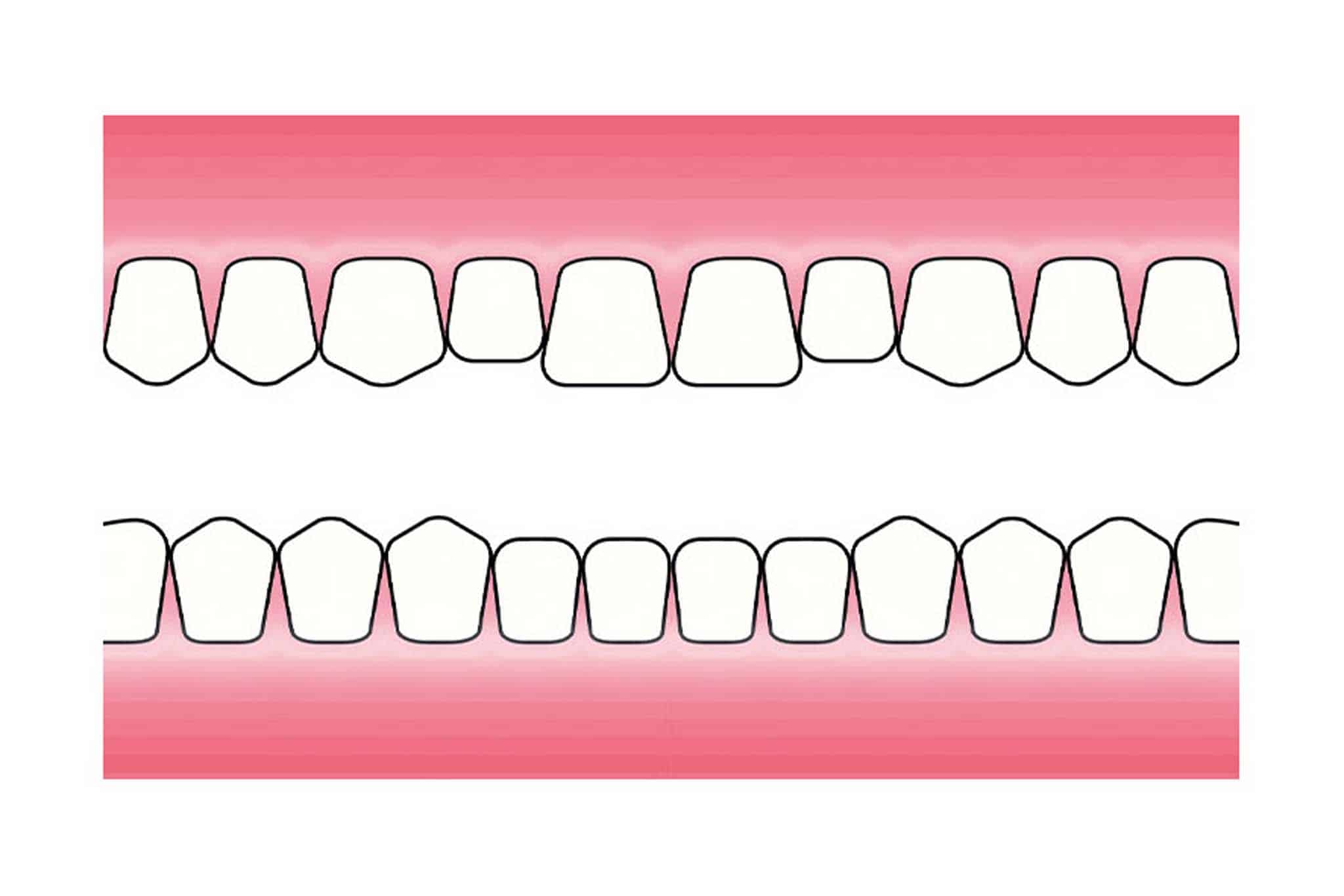 Før- og etterbilde: På Kolbotn Tannklinikk demonstreres hvordan syreskader utvikler seg – behandling for pasienter i Kolbotn, Follo og Nordstrand.