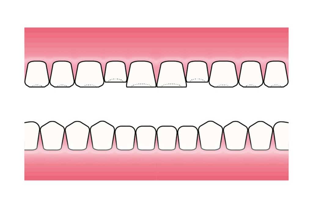 Før- og etterbilde: På Kolbotn Tannklinikk demonstreres hvordan syreskader utvikler seg – behandling for pasienter i Kolbotn, Follo og Nordstrand.
