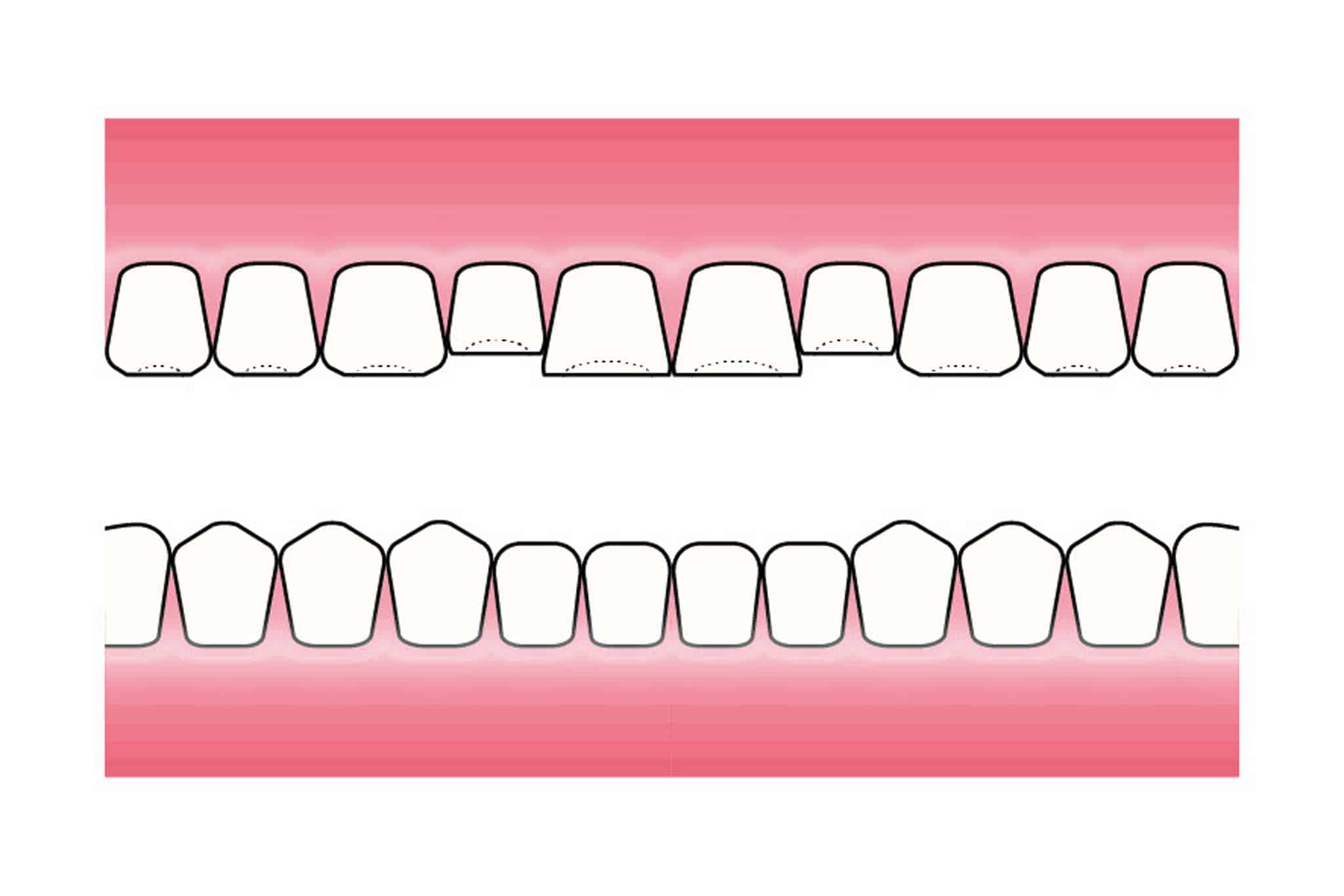 Før- og etterbilde: På Kolbotn Tannklinikk demonstreres hvordan syreskader utvikler seg – behandling for pasienter i Kolbotn, Follo og Nordstrand.