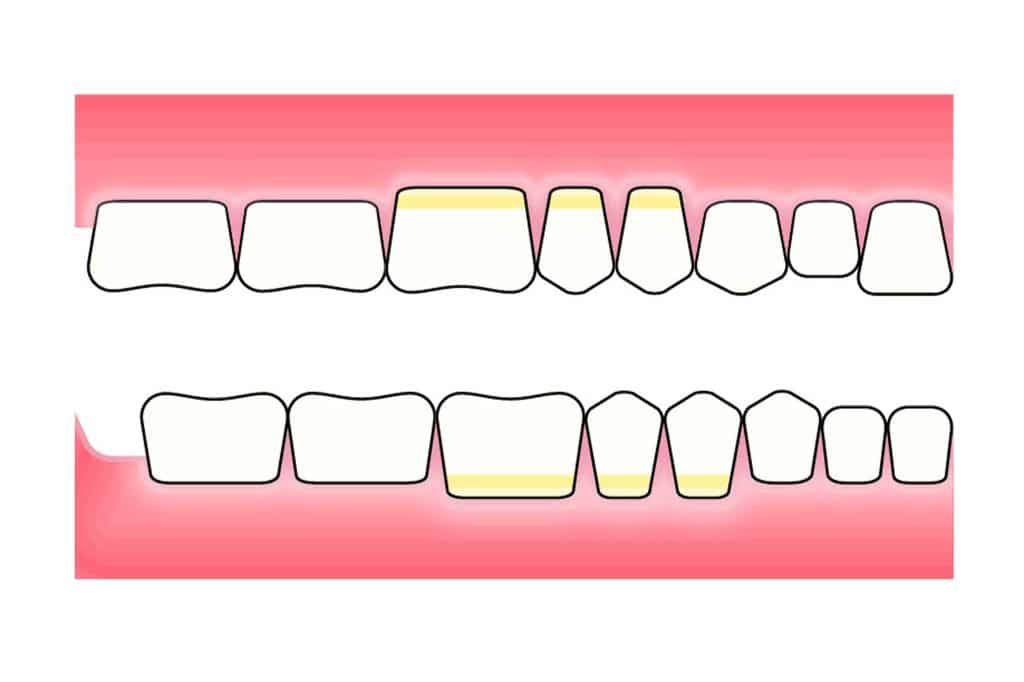 Før- og etterbilde: Ved Kolbotn Tannklinikk vises hvordan pusseskader oppstår ved tannpuss – pasientinformasjon i Kolbotn, Vinterbro og Holmlia.