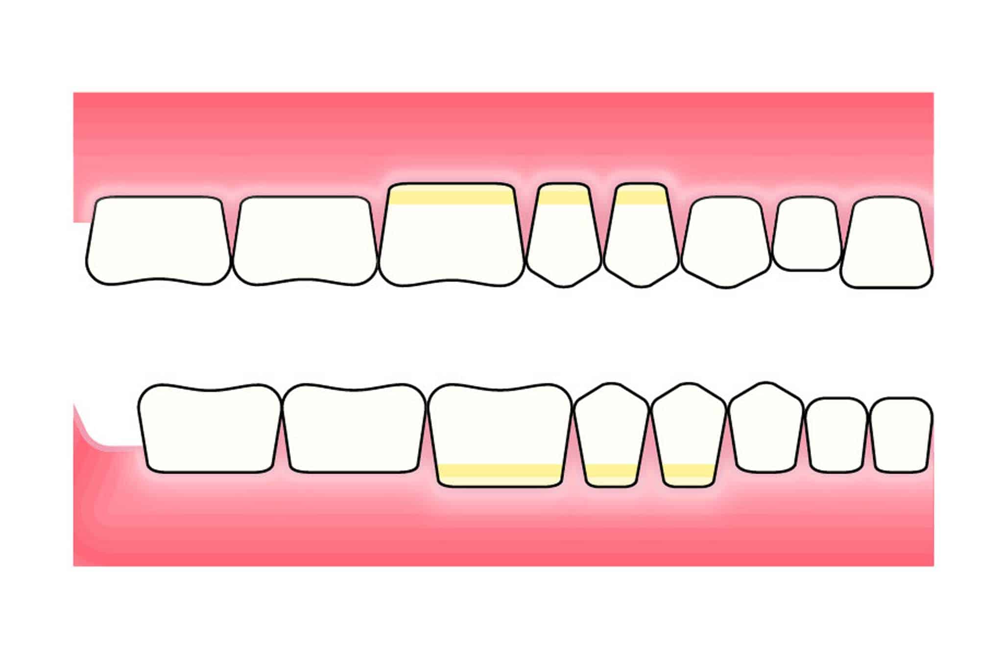 Før- og etterbilde: Ved Kolbotn Tannklinikk vises hvordan pusseskader oppstår ved tannpuss – pasientinformasjon i Kolbotn, Vinterbro og Holmlia.