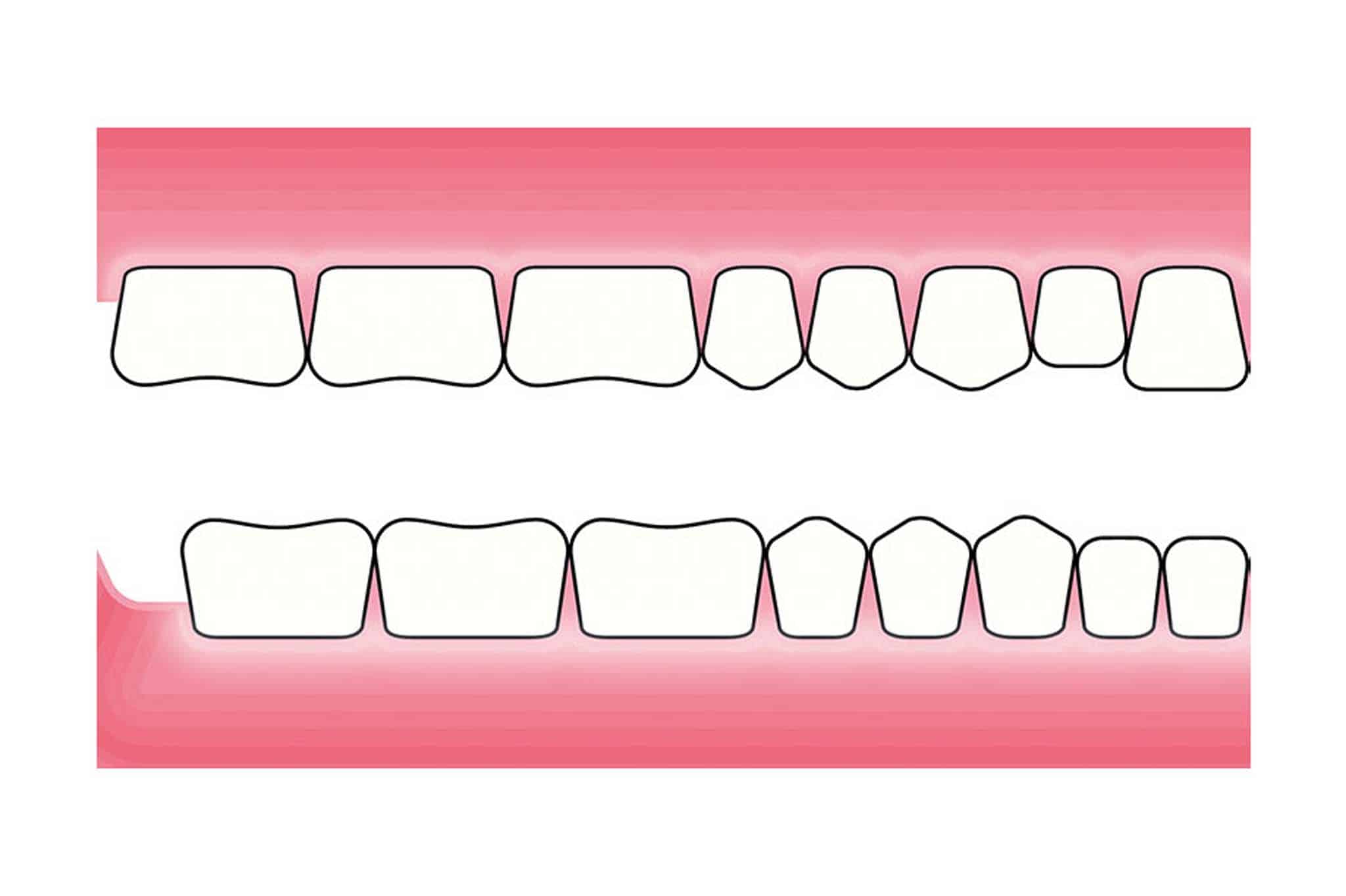 Før- og etterbilde: Ved Kolbotn Tannklinikk vises hvordan pusseskader oppstår ved tannpuss – pasientinformasjon i Kolbotn, Vinterbro og Holmlia.