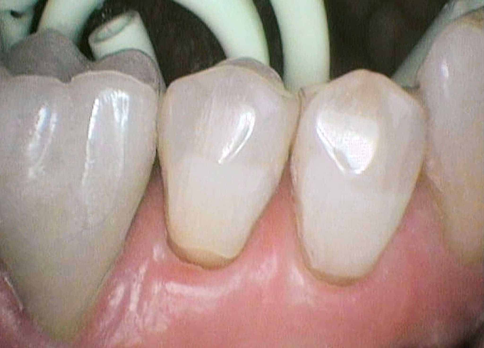 Før- og etterbilde av abrasjonsskader (pusseskader) på to tenner.