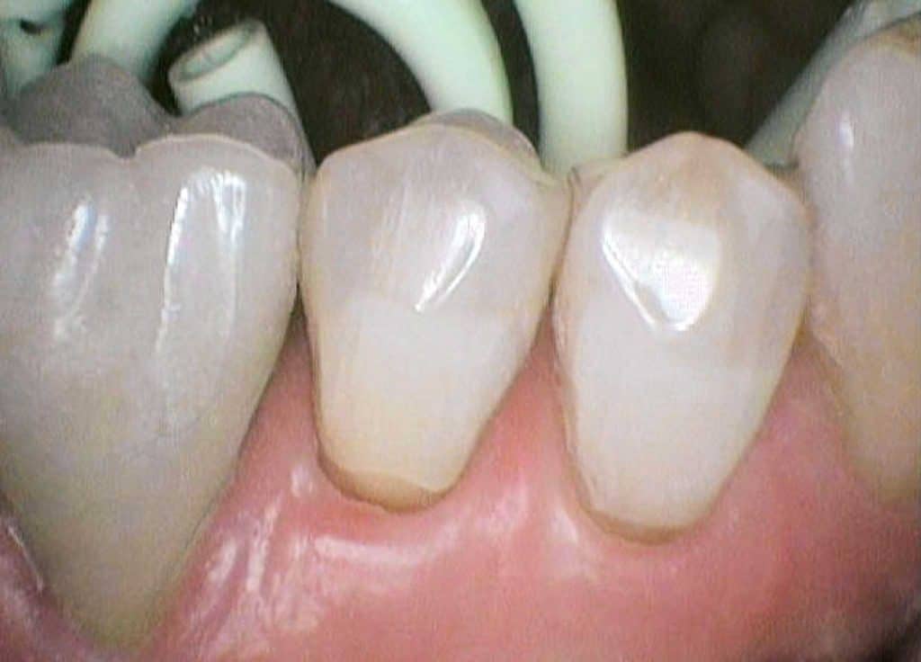 På Kolbotn Tannklinikk vises pusseskader som følge av hard tannpuss – informasjon til pasienter i Kolbotn, Oppegård og Holmlia.