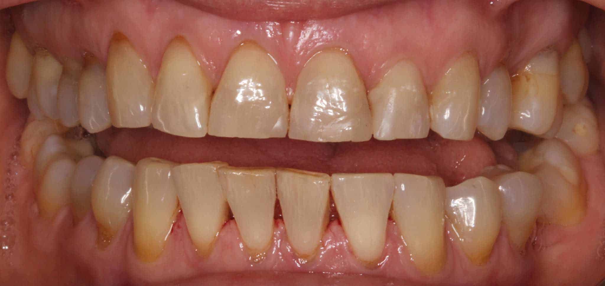 Før- og etterbilde: På Kolbotn Tannklinikk gjenoppbygges slitte tenner fra tanngnissing med tannfarget fylling – behandling i Kolbotn, Vinterbro og Holmlia.