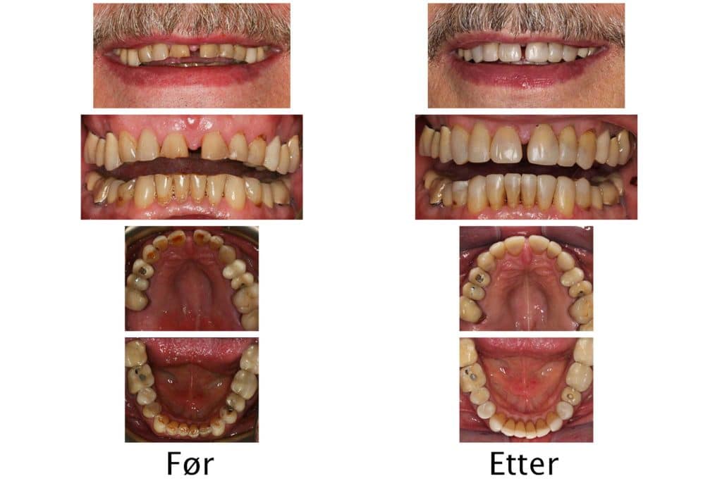 Galleri: Hos Kolbotn Tannklinikk gjenoppbygges tannsett med gnisseskader – behandling i Kolbotn, Follo og Sofiemyr.
