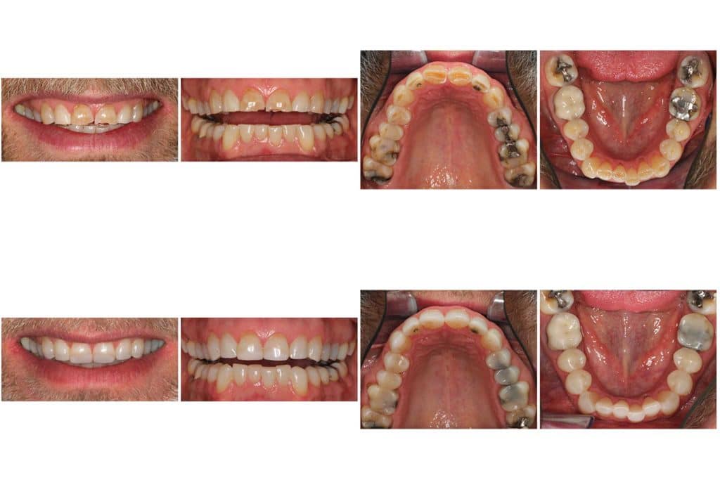 Galleri: På Kolbotn Tannklinikk behandles tanngnisseskader med tannfarget fylling – trygg behandling i Kolbotn, Oppegård og Greverud.