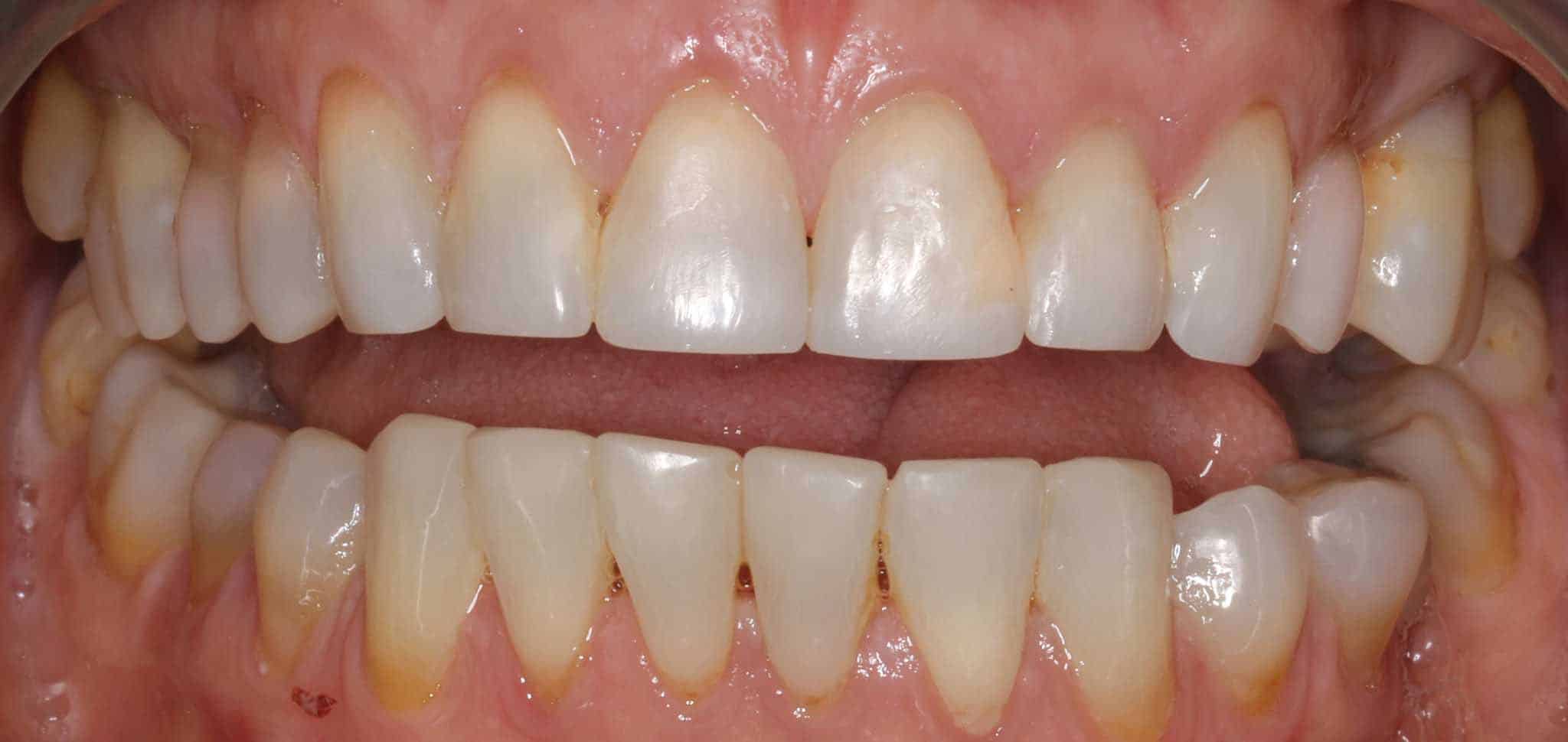 Før- og etterbilde: På Kolbotn Tannklinikk gjenoppbygges slitte tenner fra tanngnissing med tannfarget fylling – behandling i Kolbotn, Vinterbro og Holmlia.