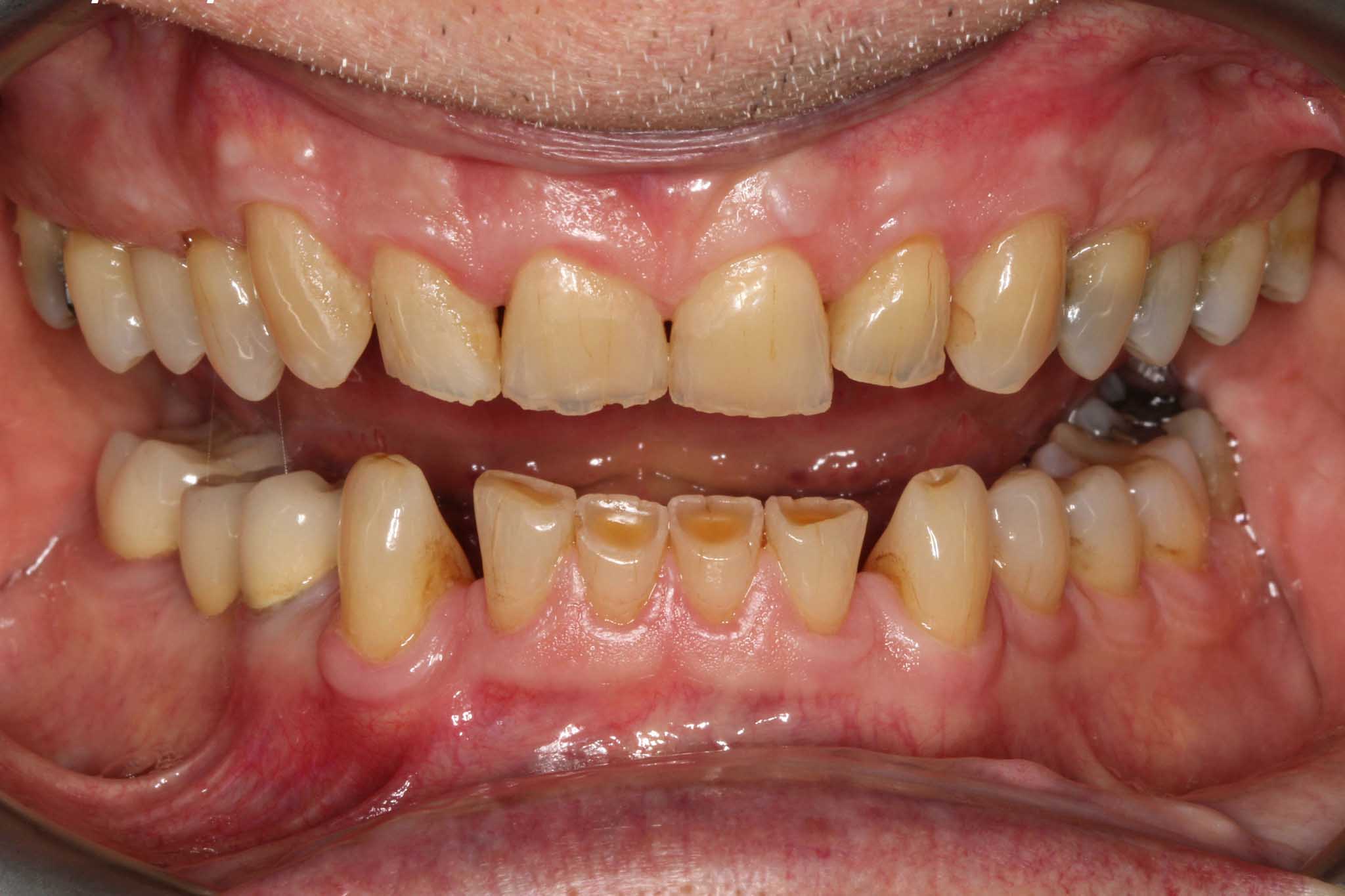 Førbilde: Hos Kolbotn Tannklinikk vises gnisseskader på tenner før oppbygging – behandling i Kolbotn, Vinterbro, Follo og Nordstran