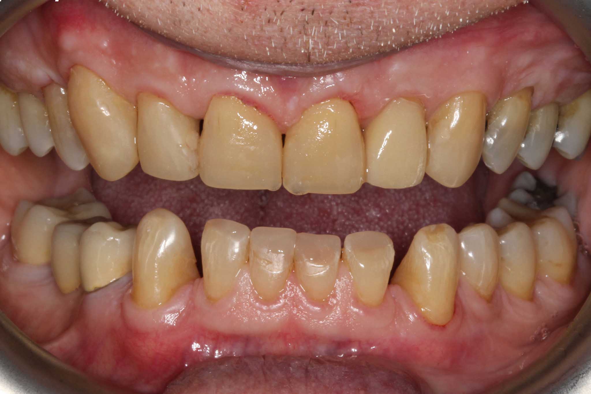 Før- og etterbilde: Ved Kolbotn Tannklinikk repareres gnisseskader og bygges opp igjen med tannfarget fylling – trygg behandling i Kolbotn, Follo, Nordstrand og Sofiemyr.