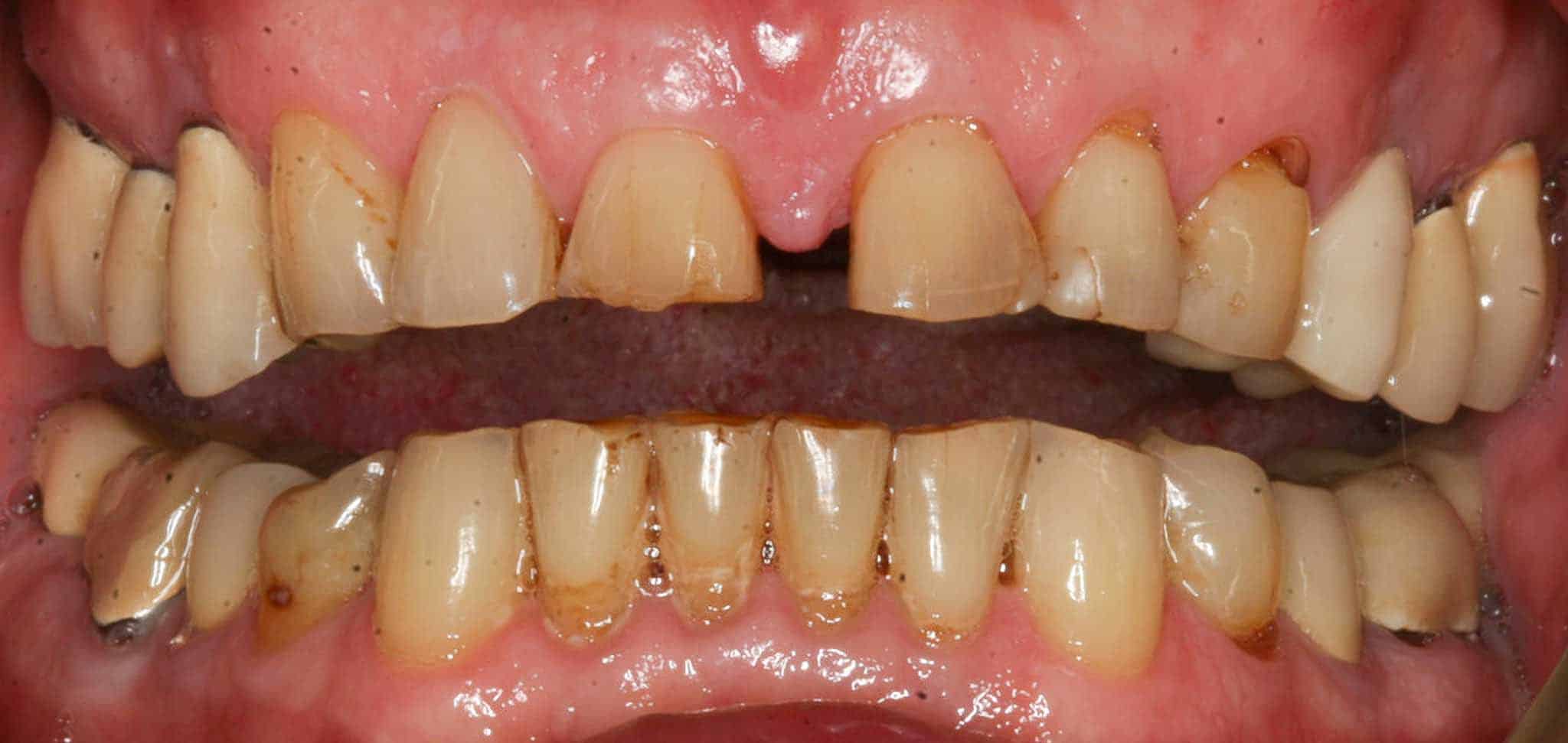 Før- og etterbilde: Hos Kolbotn Tannklinikk bygges gnisseskader opp igjen med tannfarget fyllingsmateriale – behandling i Kolbotn, Myrvoll og Greverud.