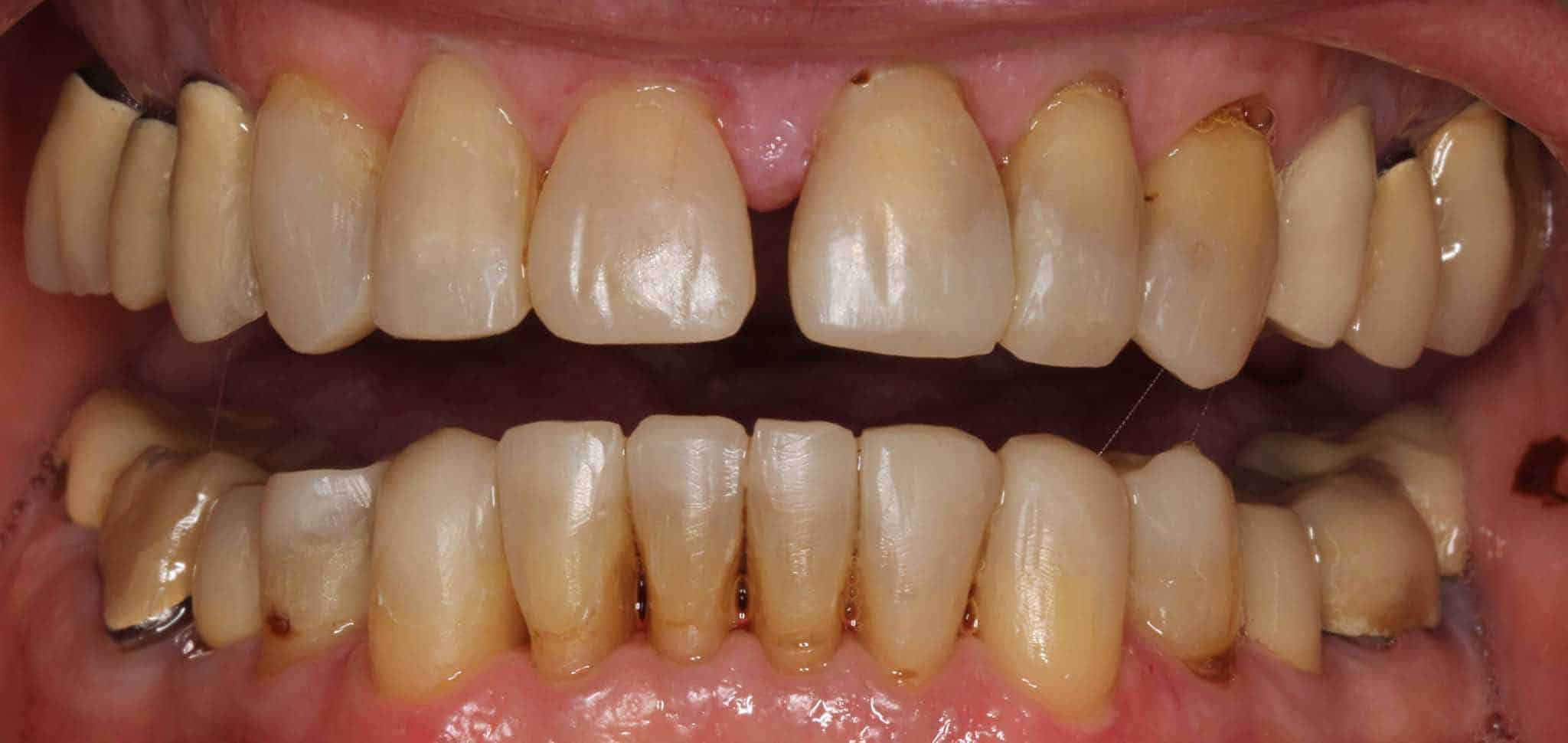 Før- og etterbilde: Hos Kolbotn Tannklinikk bygges gnisseskader opp igjen med tannfarget fyllingsmateriale – behandling i Kolbotn, Myrvoll og Greverud.