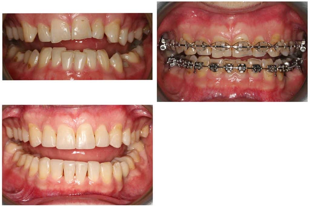 Galleri: Hos Kolbotn Tannklinikk dokumenteres behandlingsgang ved gnisseskader, inkludert regulering og oppbygging med tannfarget fylling – behandling i Kolbotn, Follo og Vinterbro.