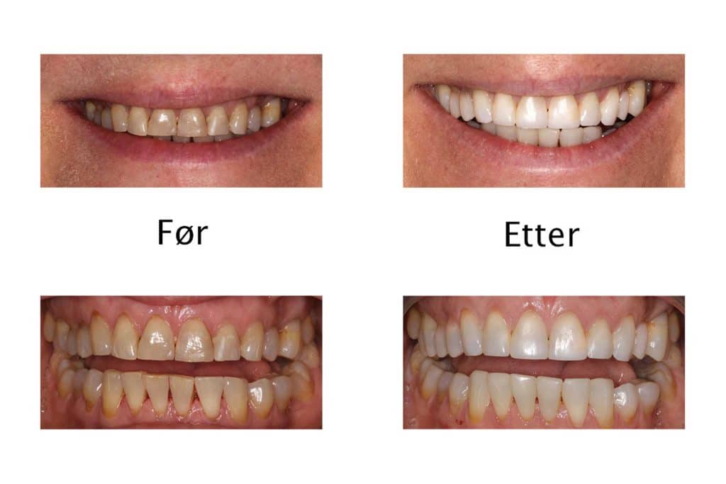 Galleri: På Kolbotn Tannklinikk behandles attrisjonsskader med tannfarget fyllingsmateriale – naturlig resultat i Kolbotn, Holmlia og Myrvoll.
