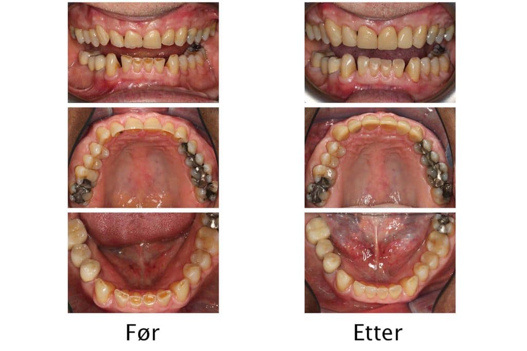 Galleri: Ved Kolbotn Tannklinikk repareres gnisseskader med tannfarget fylling – behandling i Kolbotn, Vinterbro og Nordstrand.
