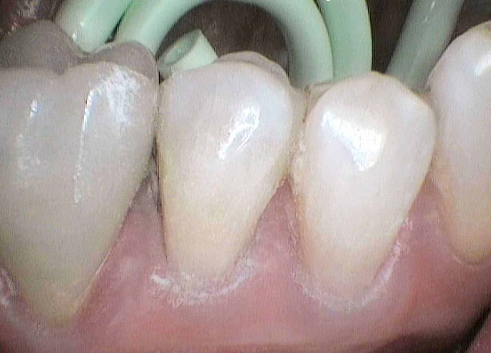 Førbilde: På Kolbotn Tannklinikk dokumenteres oppløsningsskader ved tannhalsen – behandlingstilbud for pasienter i Kolbotn, Follo og Holmlia.