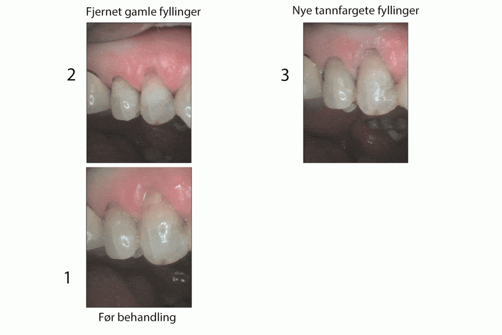 Galleri: Hos Kolbotn Tannklinikk vises prosessen fra skade til ferdig oppbygde tenner – trygg behandling i Kolbotn, Nordstrand og Sofiemyr.