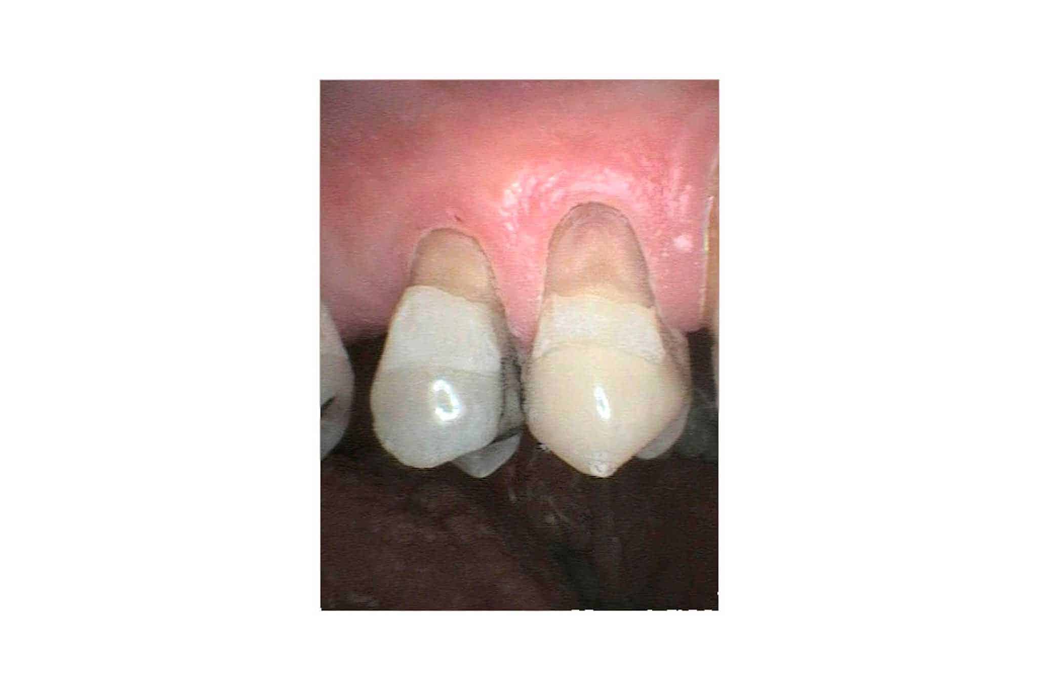 Før- og etterbilde: Ved Kolbotn Tannklinikk bygges tenner med abfraksjonsskader opp igjen med tannfarget fylling – trygg behandling i Kolbotn, Vinterbro, Myrvoll og Sofiemyr.