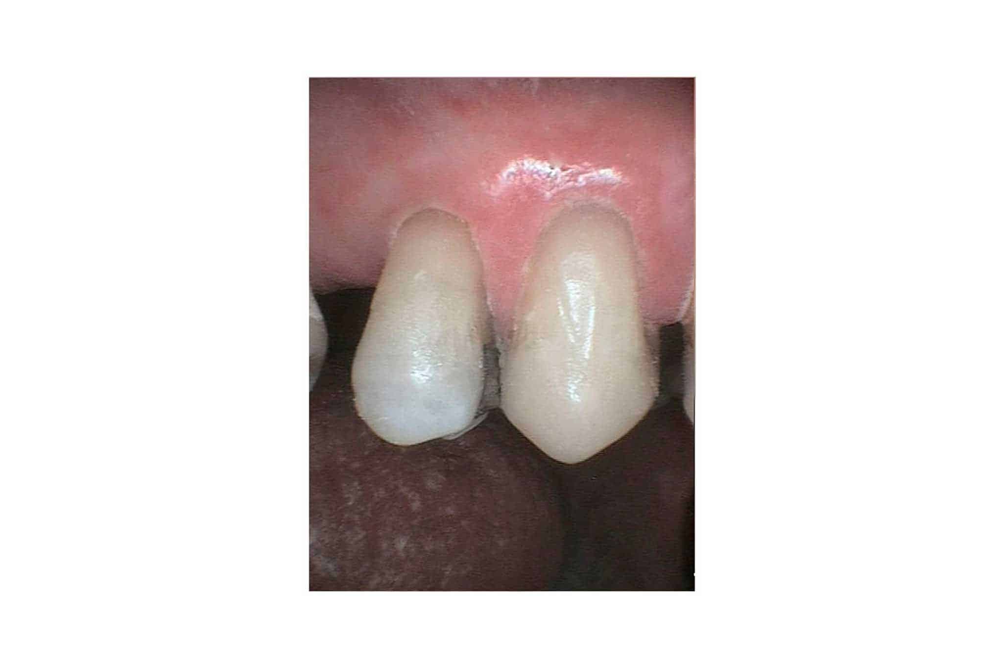 Før- og etterbilde: Ved Kolbotn Tannklinikk bygges tenner med abfraksjonsskader opp igjen med tannfarget fylling – trygg behandling i Kolbotn, Vinterbro, Myrvoll og Sofiemyr.