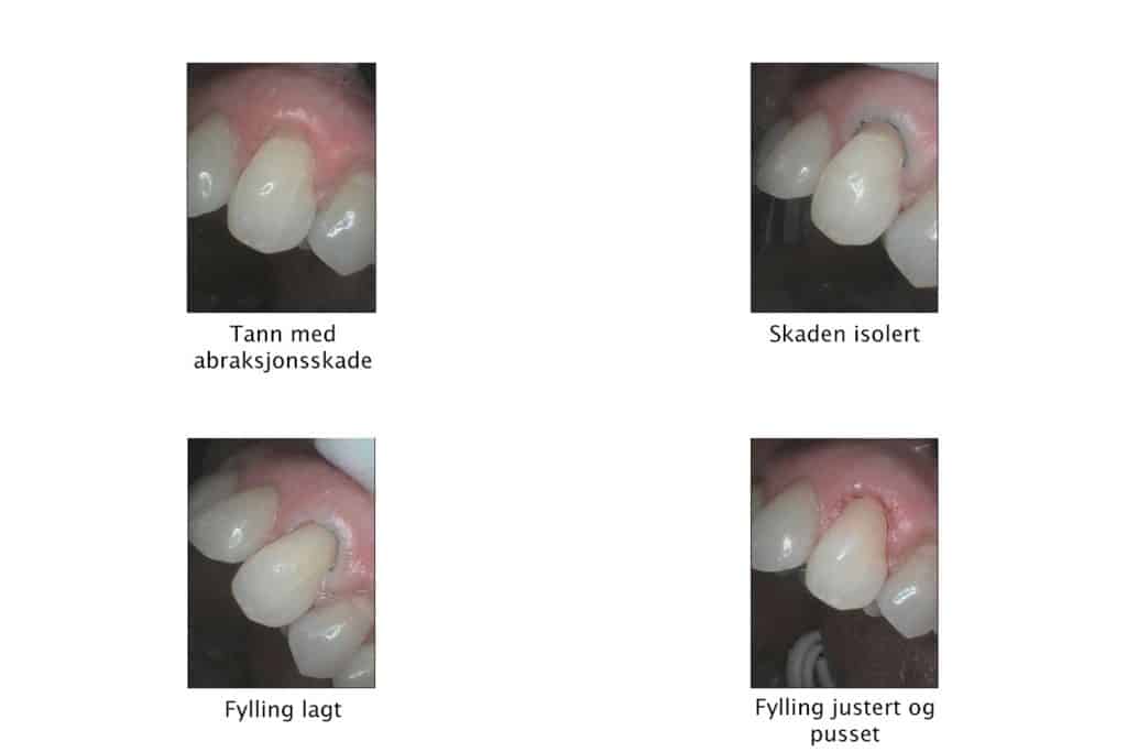 Galleri: Hos Kolbotn Tannklinikk dokumenteres stegvis behandling av abfraksjonsskade – behandling i Kolbotn, Follo og Oppegård.