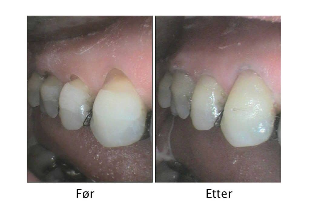 Galleri: På Kolbotn Tannklinikk behandles flere tenner med oppløsningsskader ved tannhalsene – behandling i Kolbotn, Vinterbro og Holmlia.