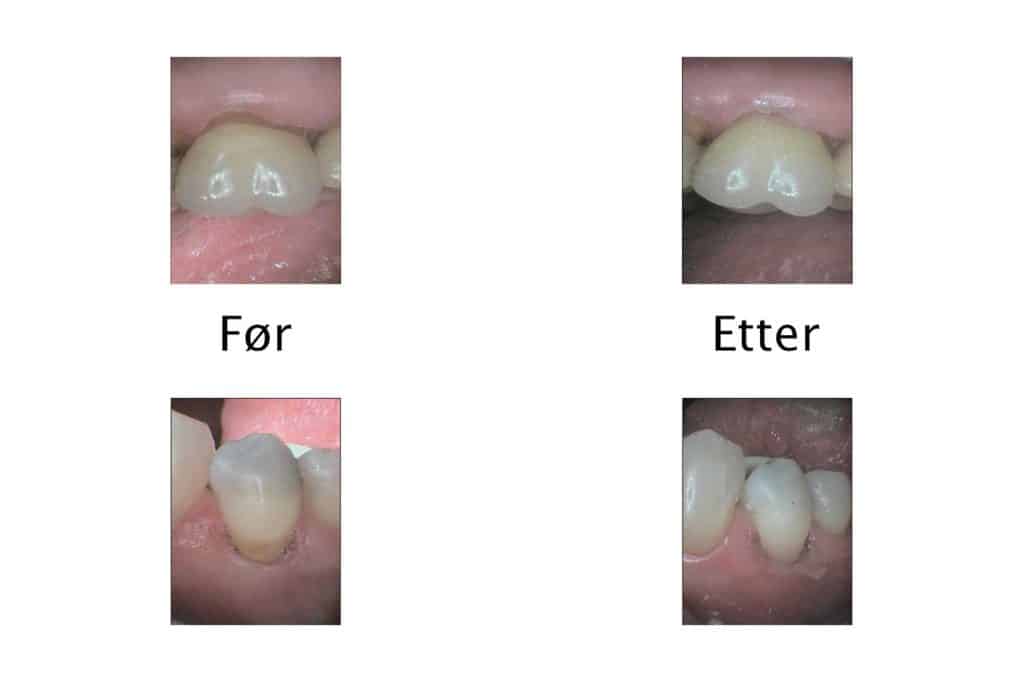Galleri: Ved Kolbotn Tannklinikk repareres oppløsningsskader på to tenner med tannfarget fylling – behandling i Kolbotn, Follo og Myrvoll.